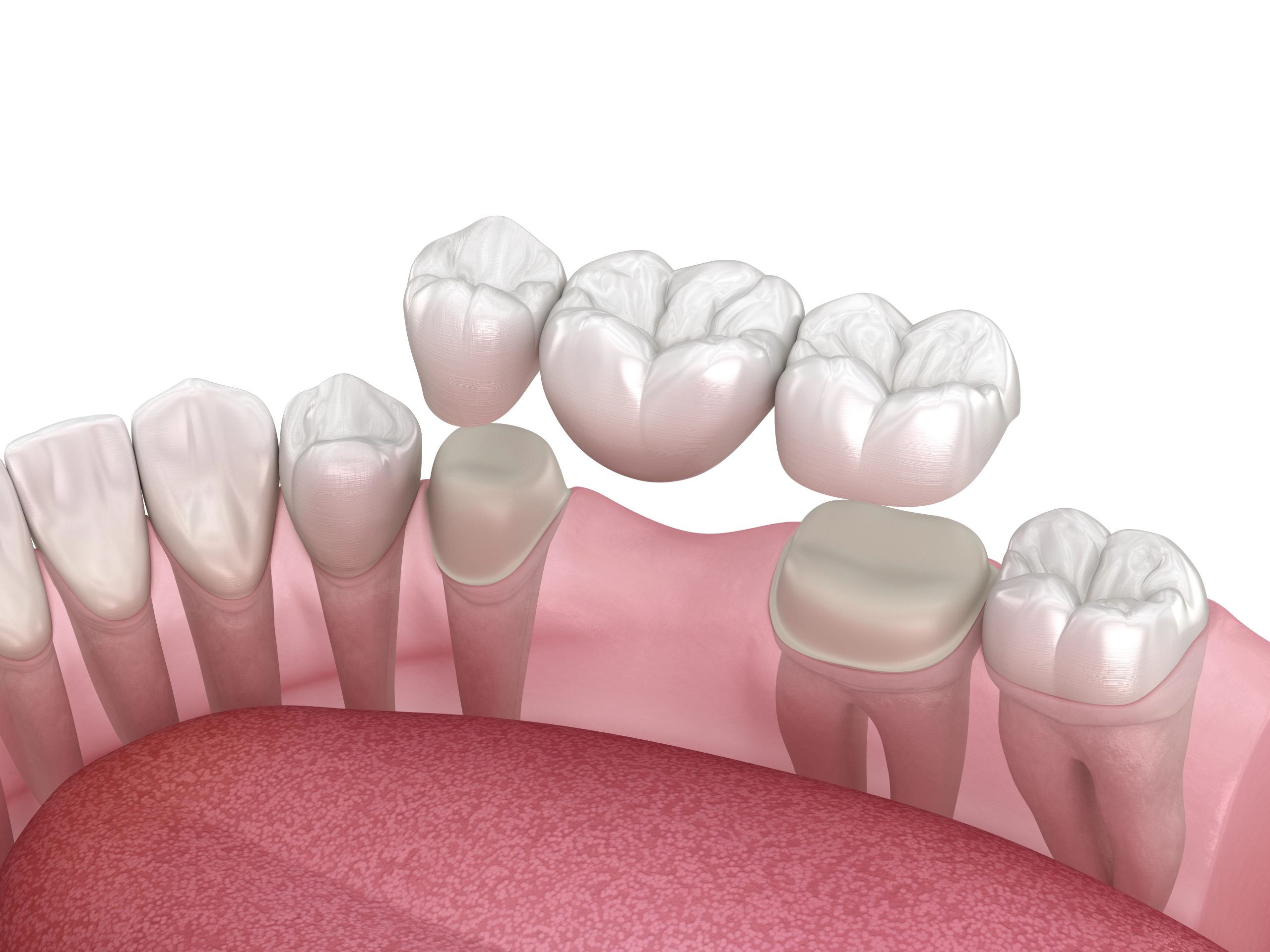 Discover the Best Option for Your Smile with Dental Bridges Succasunna and Implants