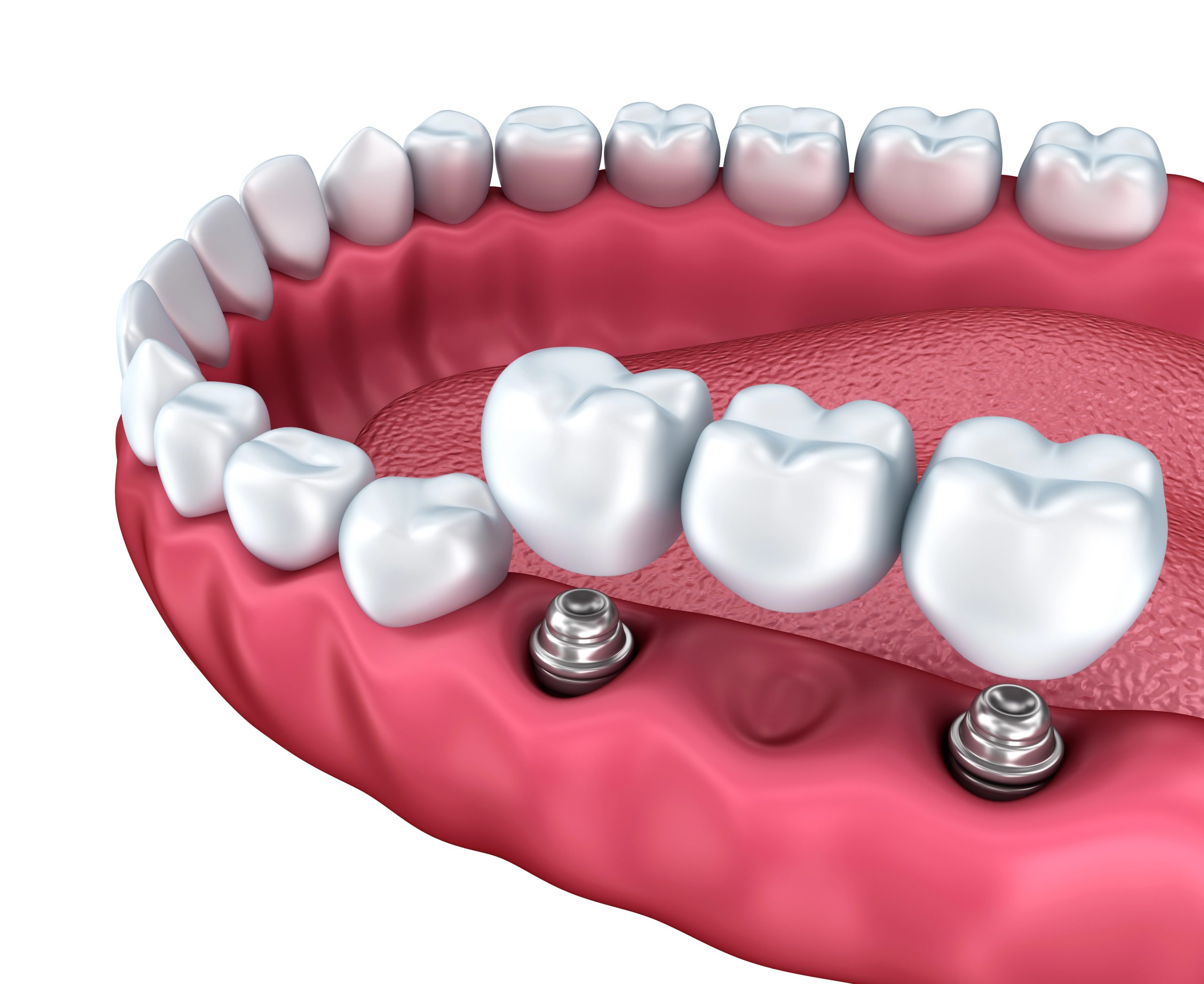 Discover the Benefits and Considerations of Dental Bridges Succasunna for Seniors