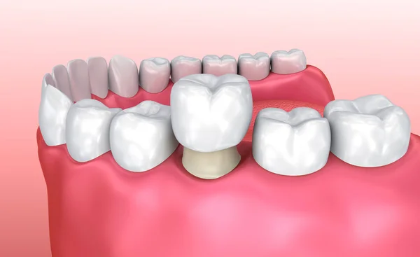 Dental Crown Procedure in Succasunna, NJ: What to Expect